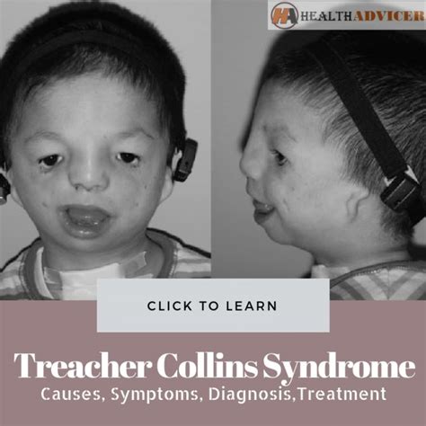 Treacher Collins Syndrome: Causes, Picture, Symptoms, And Treatment