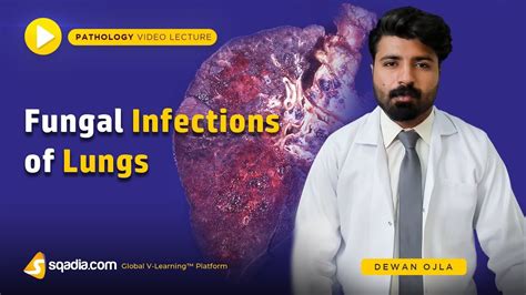 Fungal Infections Of Lungs Pathology Lectures Medical Education