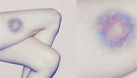 Bruise Easily? 8 Facts You Need To Know | SELF