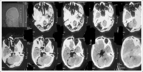 B Post Op Ct Scan Figure 1 Infratentorial Cpa Epidermoid Cyst