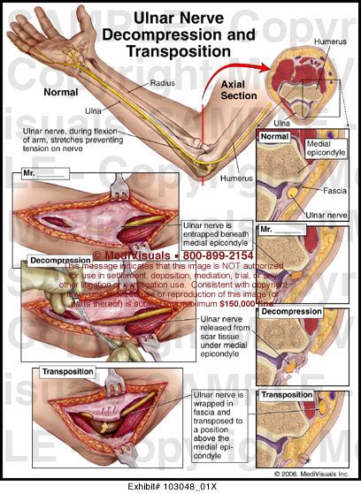 Decompression: Ulnar Nerve Decompression Surgery Video