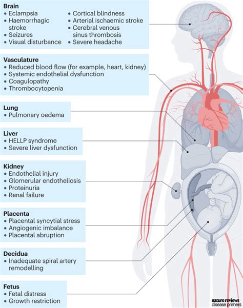 Nature Reviews Disease Primers On Twitter Preeclampsia Is Defined As