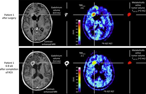 Patient Example Of Pseudoprogression Patient 1 Brain Imaging After