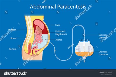 29 Paracentesis Stock Vectors, Images & Vector Art | Shutterstock