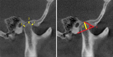 Three Dimensional Cone Beam Computed Tomography Based Comparison Of Condylar Position And