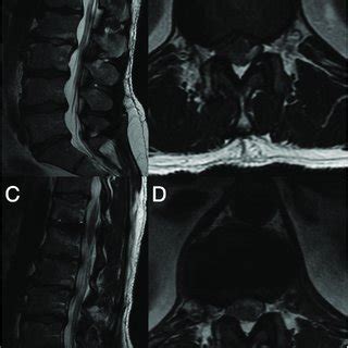 Preoperative Sagittal A And Axial B T2 Weighted Magnetic Resonance