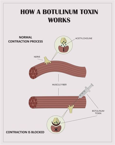 5 Botulinum Toxin Mechanism Royalty-Free Images, Stock Photos ...