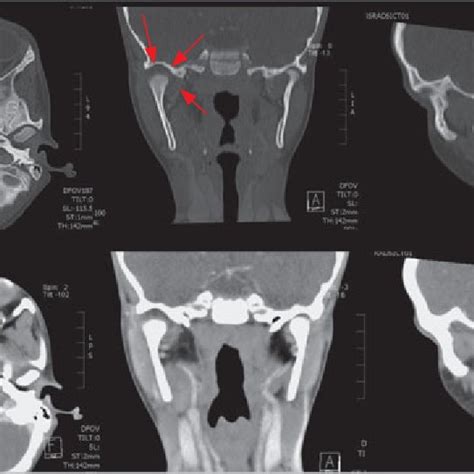 Mild preauricular swelling (right-sided). Fig 2 Maximal interincisal ...