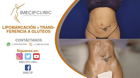 Cl Nica Imecip Lipomarcaci N Abdominal Transferencia A Gluteos