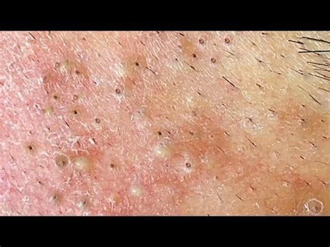 Relax Every Day With Sac Dep Spa 0242 YouTube Zits Popping Zit