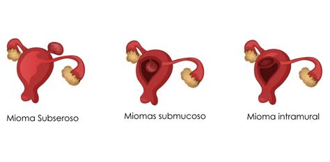 Mioma Subseroso O Que É - O que são Miomas Uterinos? Descubra agora!