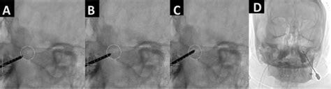 A C Lateral Fluoroscopic Views Demonstrate Step By Step Advancement