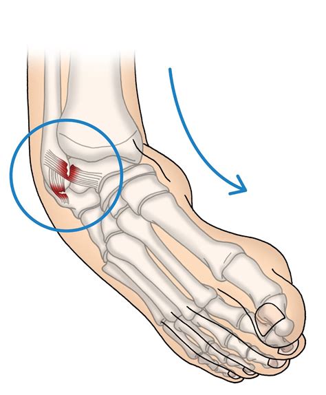 Medical Illustrations for Foot and Ankle Surgery — Sarah Locher – Freelance Illustrator from Hamburg