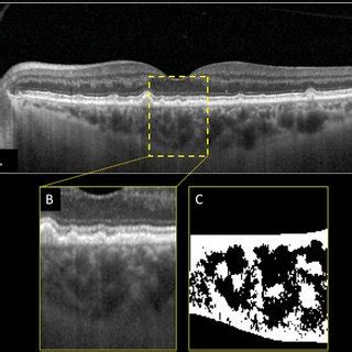 Structural Optical Coherence Tomography OCT And Choroidal Vascularity