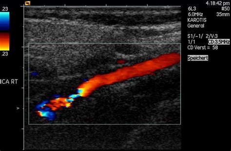 Doppler Effect Ultrasound