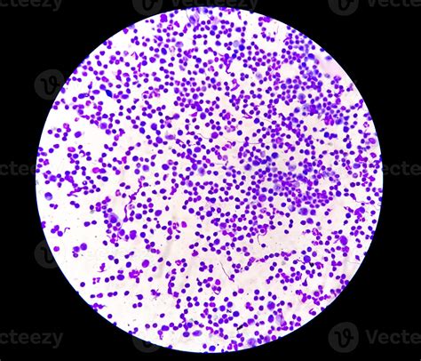 Synovial Fluid Cytology Plenty Wbc Microscopic Examination Of