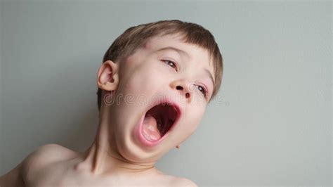 The Boy Yawning And Stretching With A Swollen Eye From An Insect Bite