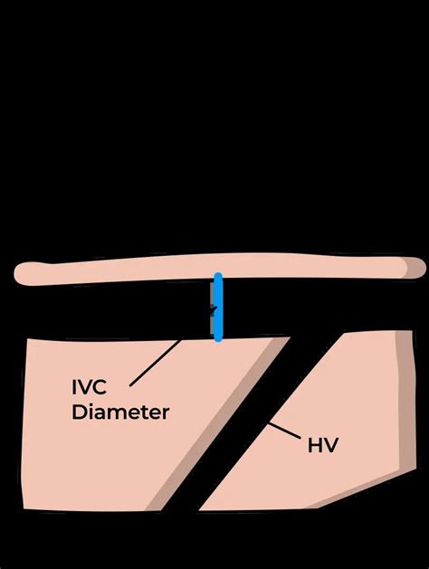 Central Venous Pressure Cvp