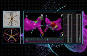 Pulse Biosciences Announces First Human Use Of Pulsed Field Ablation