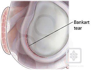 Kinesiology Sport Review Shoulder Injuries Labral Tears