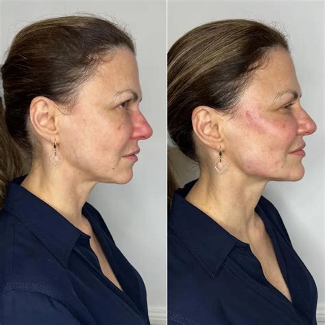 Cheek Filler Derma Aesthetics London