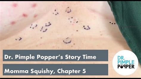 Dr Pimple Poppers Weekly Story Time Momma Squishy Chapter 5 Youtube