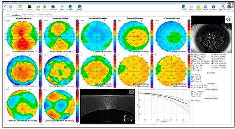 Tech Update Introducing The Ms Anterior Segment Oct Parkhurst