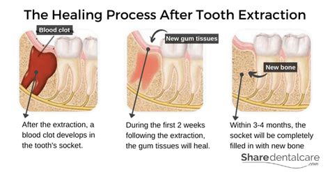 Tooth Extraction Aftercare (Instructions): The Dos & Don’ts 