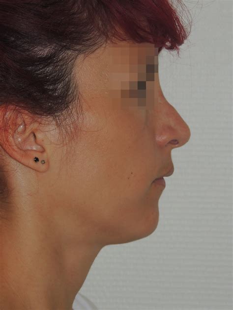 Avant Apr S Rhinoplastie G Nioplastie Du Docteur Martin