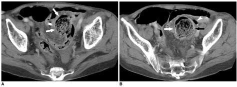 90 Year Old Man With Stercoral Perforation Of Sigmoid Colon A Download Scientific Diagram