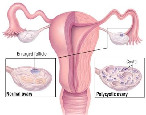 Polycystic Ovarian Syndrome Pcos Dr Nitu Bajekal