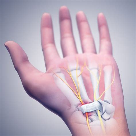 How To Treat Carpal Tunnel Syndrome Without Surgery Tanya Coats Occupational Therapy