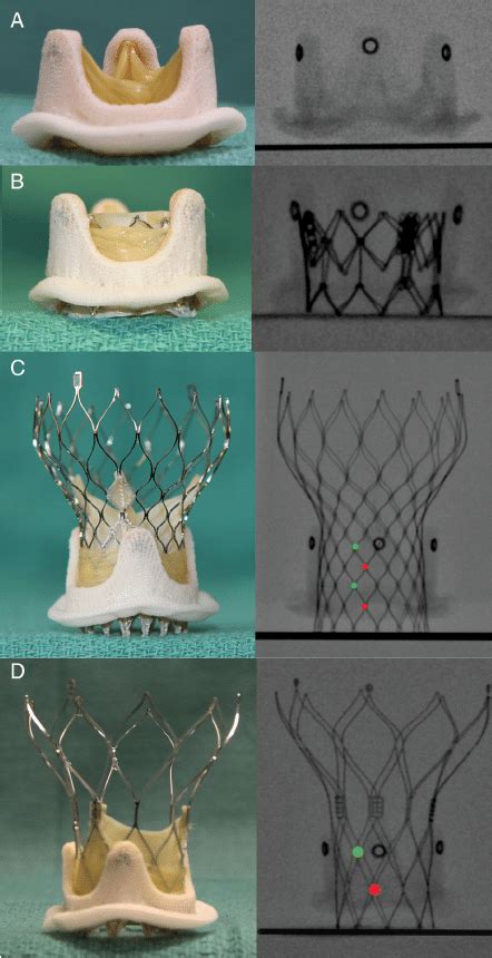 Transcatheter Heart Valve Placement Within The Mosaic Valve Medtronic