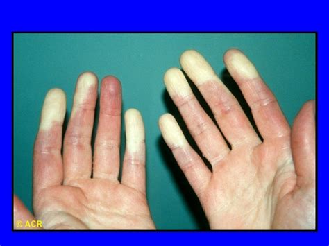 7 13 Connective Tissue Disease