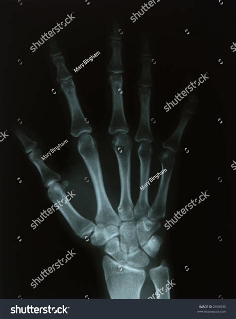 Xray Young Womans Hand Stock Photo (Edit Now) 2698830