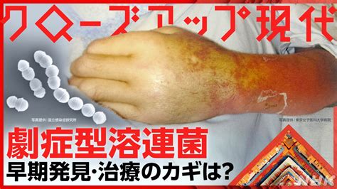 急拡大・致死率3割「劇症型溶連菌」 原因は対処法は クローズアップ現代 Nhk