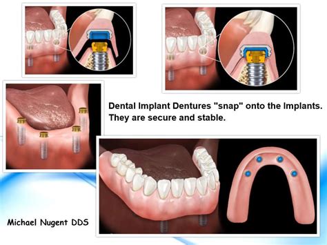 Dental Implants Replace Missing Teeth Dental Implant Dentist Pasadena