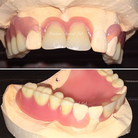 How To Remove Flexible Partial Dentures Clarence Begay