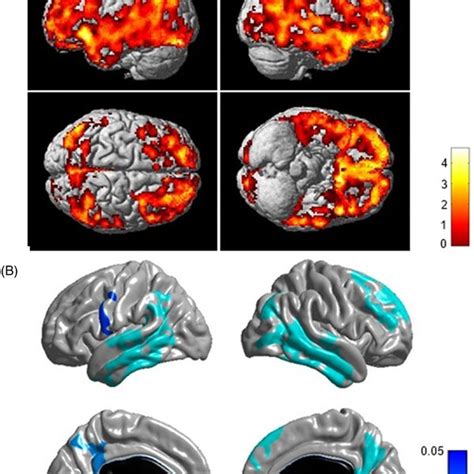 Association Of Rs10751647 With Brain Amyloid Deposition In Amyloid PET