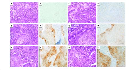 Representative Results Of Pd L1 Clone Sp263 Ihc Expression By Tps