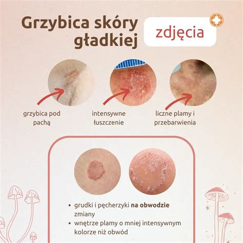 Grzybica Sk Ry Jak Wygl Da Zdj Cia Objawy Przyczyny Jak Ma