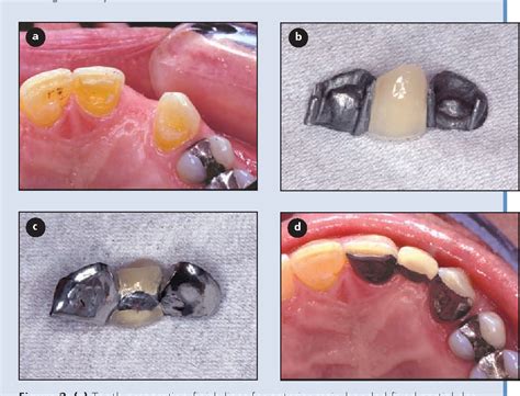 Figure From Resin Bonded Fixed Partial Dentures What S New