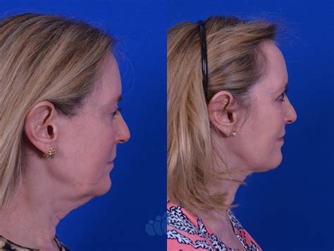 Facelift Before And After Pictures Case 61 Charlotte Nc Dilworth Facial Plastic Surgery