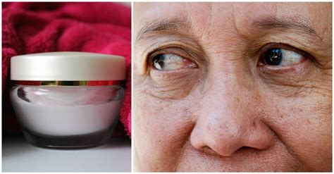 Brilliant Dermatologist-Approved Ways To Get Rid Of Wrinkles Under Your Eyes | DoYouRemember?