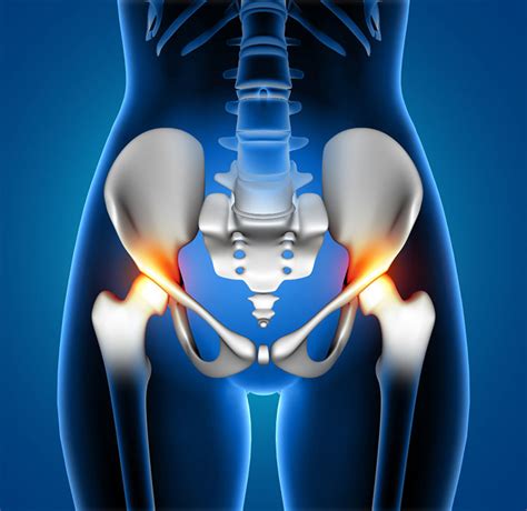 Fisioterapia Para La Fractura De Cadera Cl Nica Capacity