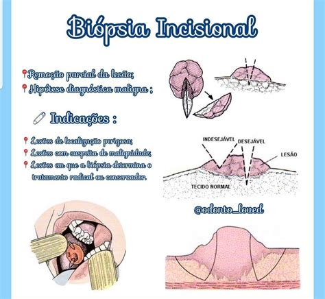 Bi Psia Incisional Cirurgia