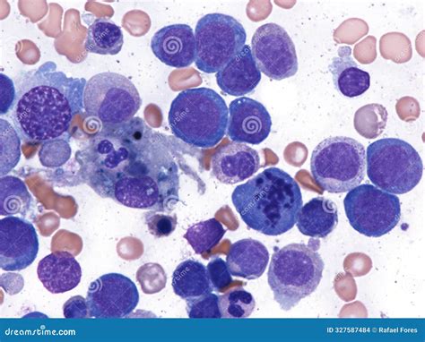 Myelodysplastic Syndrome Bone Marrow Stock Photo Image Of Marrow