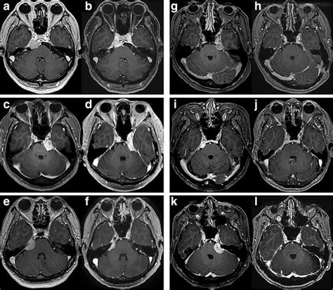 Pre And Postoperative Gadolinium Enhanced T Weighted Axial Mr Images