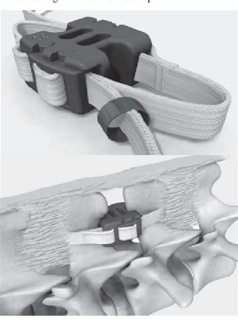 figure   dynamic stabilization devices   treatment