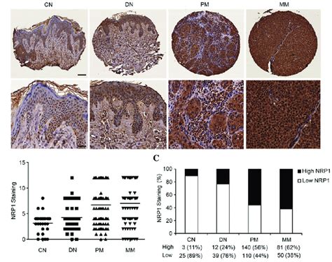 Increased Nrp1 Expression Is Correlated With Melanoma Progression A